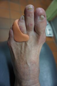 Trine Martinsen har laget en silikontå til Anne Brit Berdal, som hun enkelt setter på når hun bruker sko.