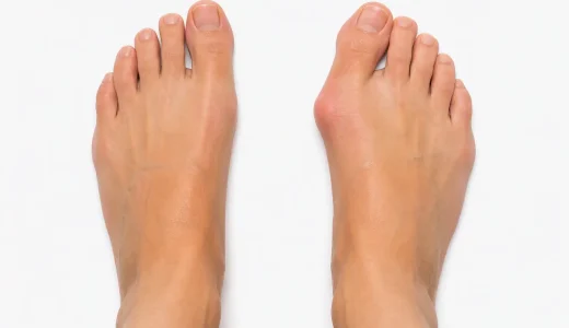 Stiv stortå – hallux limitus og hallux rigidus
